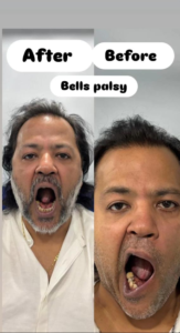bells palsy before and after 